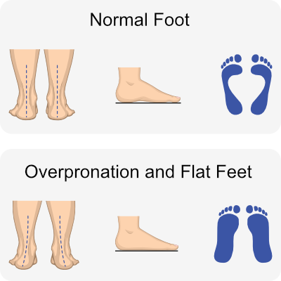 illustration of overpronation (flat feet) compared to normal feet