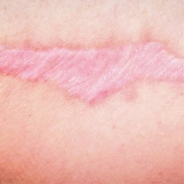 tissue healing collagen synthesis
